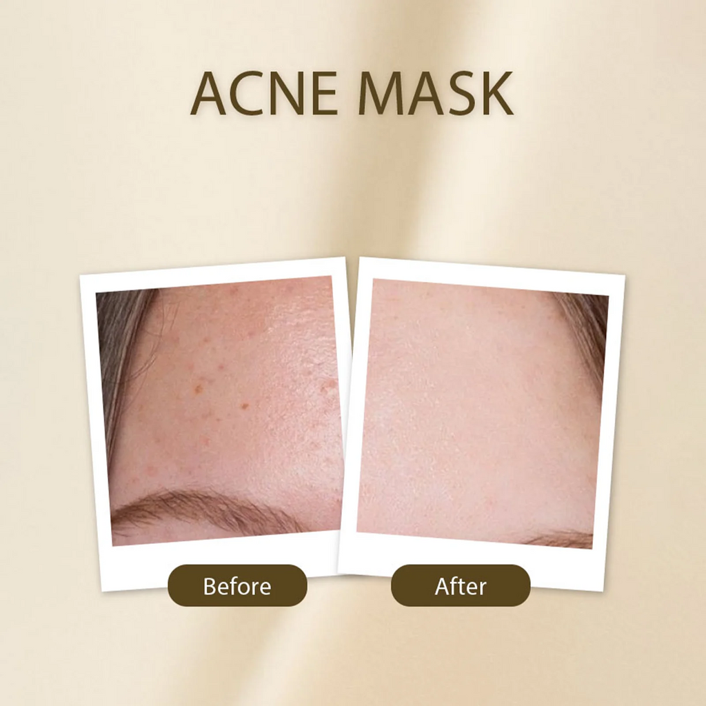 Golden Girl Acne Mask