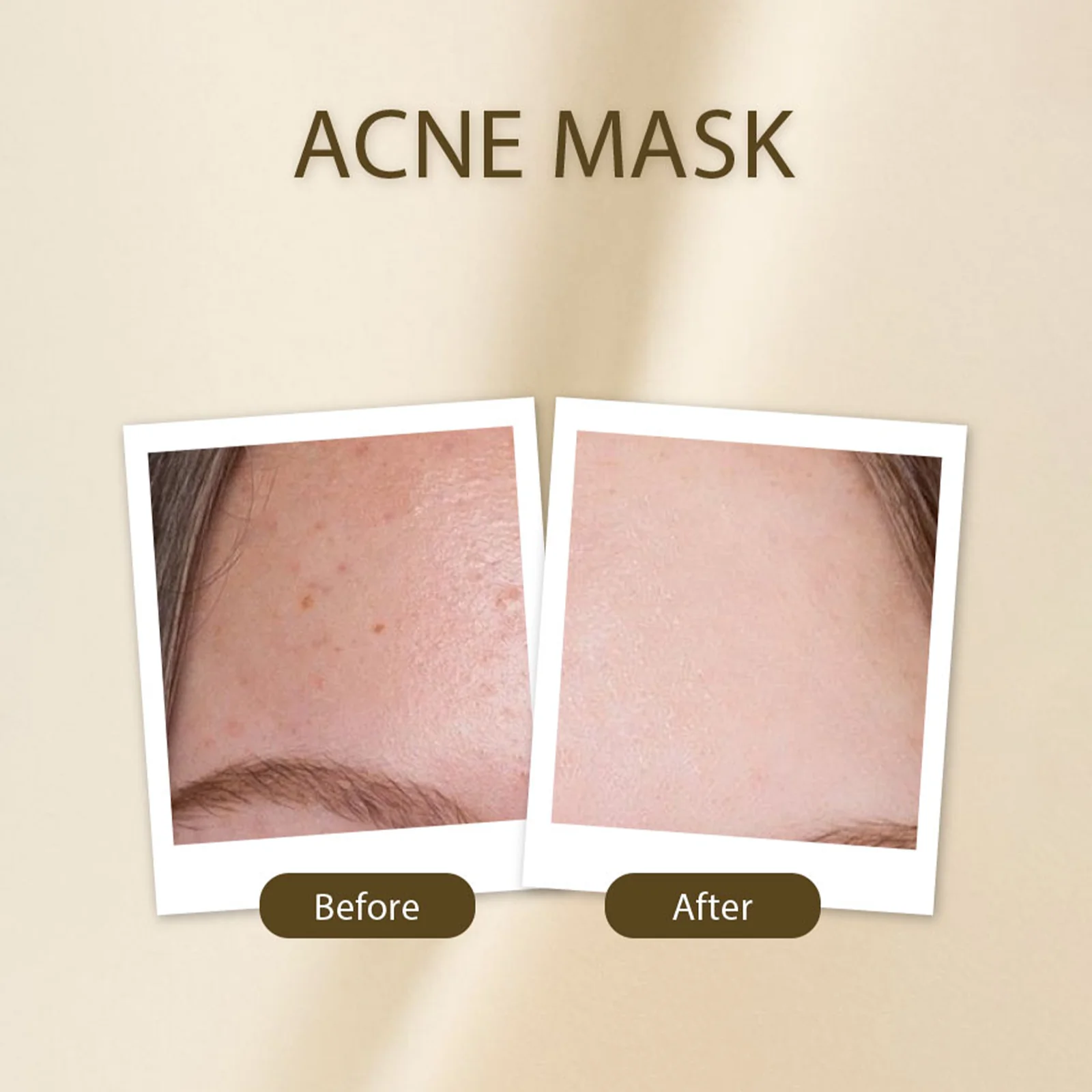 Golden Girl Acne Mask