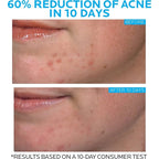 Before and after comparison of acne reduction on a person's face with text indicating 60% reduction in 10 days.