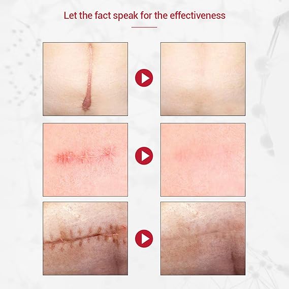 Scar Remover Gel for Scars, Scar Repairing Gel